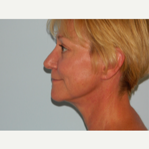 55-64 year old woman treated with Facelift after 3266373