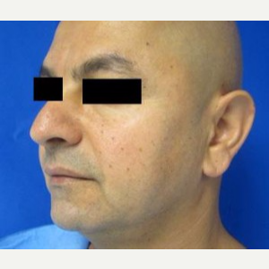 Chin Implant before 3164301