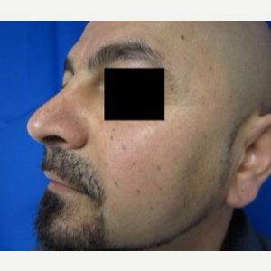 Chin Implant after 3164301