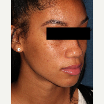 18-24 year old woman treated with PicoWay after 3244573