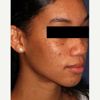 18-24 year old woman treated with PicoWay before 3244573