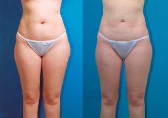 28-year-old woman treated with Liposuction. before 3287342