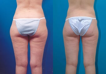 28-year-old woman treated with Liposuction. after 3287342