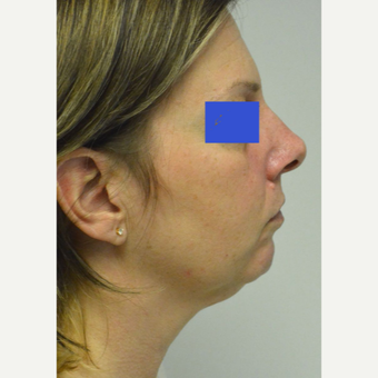 45-54 year old woman treated with Kybella before 3500777