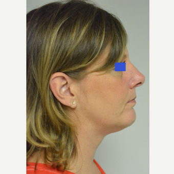 45-54 year old woman treated with Kybella after 3500777