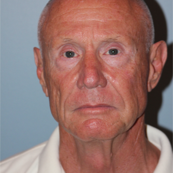 67 year old man treated with a Neck Lift before 3465120