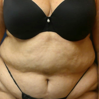 65-74 year old woman treated with Liposuction before 3568237