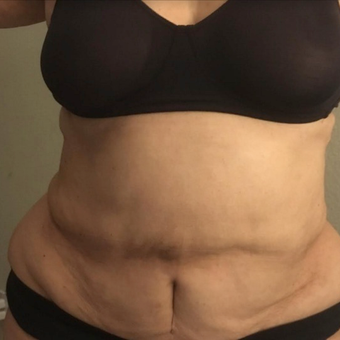 65-74 year old woman treated with Liposuction after 3568237