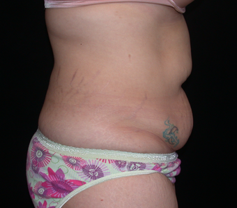 Tummy Tuck before 275751