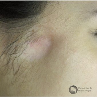 18-24 year old woman treated with Scars Treatment before 3325465