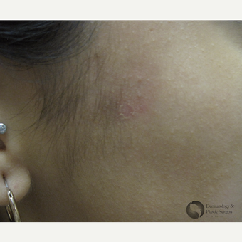 18-24 year old woman treated with Scars Treatment after 3325465