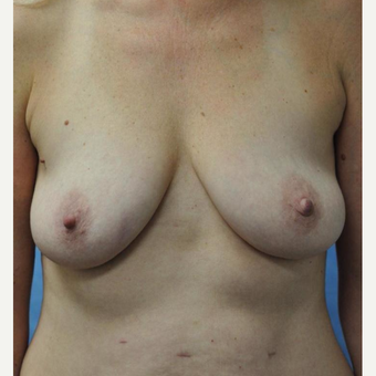 45-54 year old woman treated with Breast Lift with Implants before 3440922