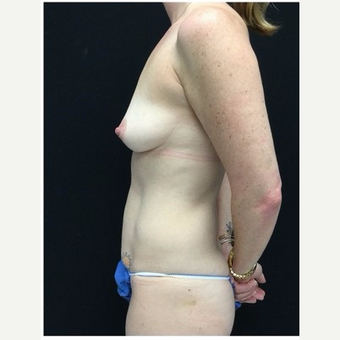 35-44 year old woman treated with Mommy Makeover 4 months post op before 3185535