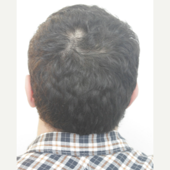 25-34 year old man treated with FUE Hair Transplant after 3068875