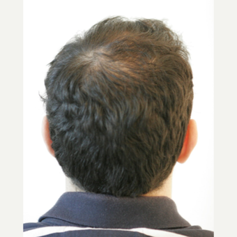 25-34 year old man treated with FUE Hair Transplant before 3068875