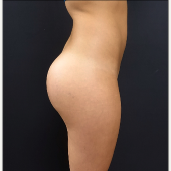 25-34 year old woman treated with 548cc Silicone Butt Implants after 3033266