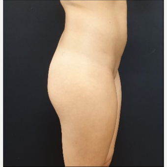 25-34 year old woman treated with 548cc Silicone Butt Implants before 3033266
