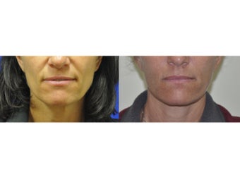 Lower Facelift/Necklift and Fat Transfer before 519070