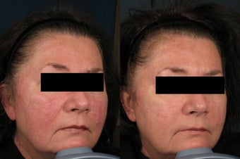Rosacea Treatment before 1039867