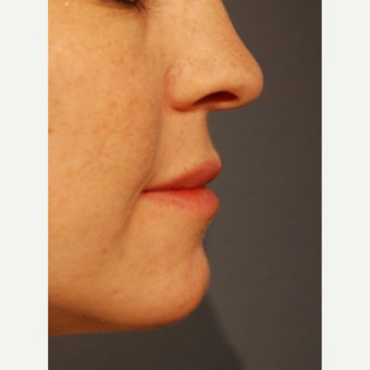 25-34 year old woman treated with Restylane Silk for Lip Augmentation after 3065327