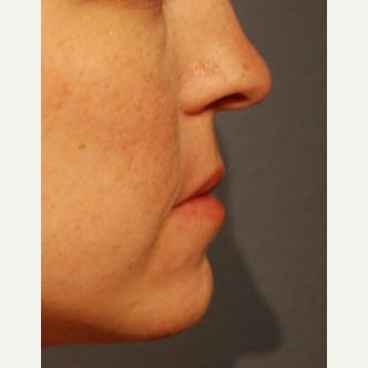25-34 year old woman treated with Restylane Silk for Lip Augmentation before 3065327