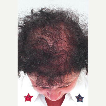 Hair Transplant after 3241467