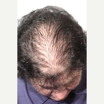 Hair Transplant before 3241467
