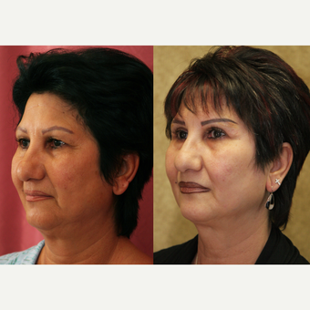Eyelid surgery before and after pictures before 3424061