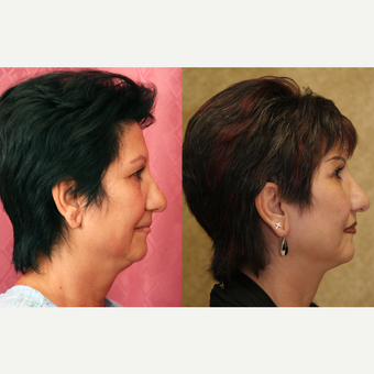 Eyelid surgery before and after pictures after 3424061
