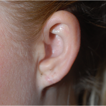 18-24 year old woman treated with Facial Reconstructive Surgery after 2976227
