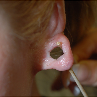 18-24 year old woman treated with Facial Reconstructive Surgery before 2976227