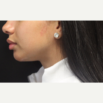18-24 year old woman treated with Chin Implant after 3259411