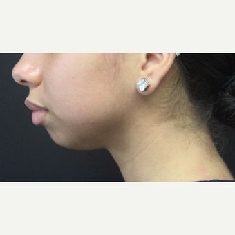 18-24 year old woman treated with Chin Implant before 3259411