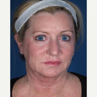 Facelift before 2564512