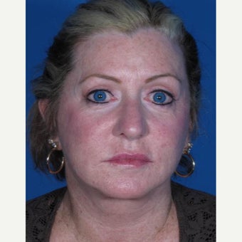 Facelift after 2564512