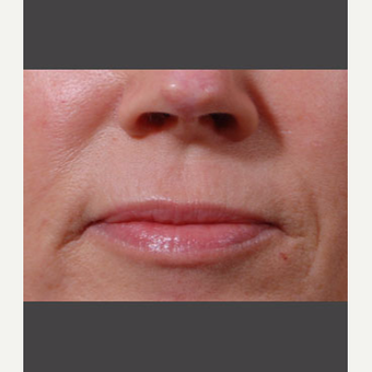 55-64 year old woman treated with Juvederm before 3725319