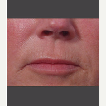 55-64 year old woman treated with Juvederm after 3725319