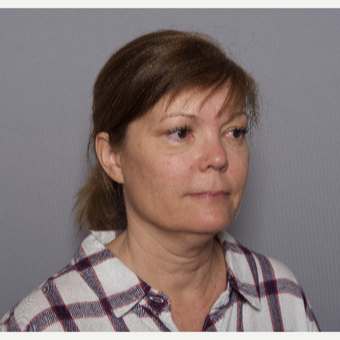 45-54 year old woman treated with Facelift before 3606003