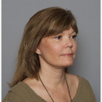 45-54 year old woman treated with Facelift after 3606003