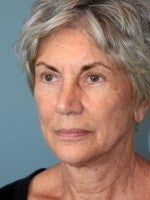 65-74 year old woman treated with Neck Lift before 3103959