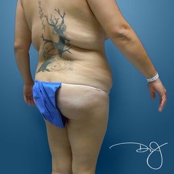 Fat Transfer to Buttock before 864939