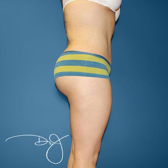 Fat Transfer to Buttock 864939