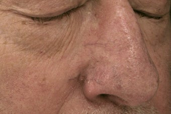 nose vessels treated with pulsed dye laser (PDL) before 821610