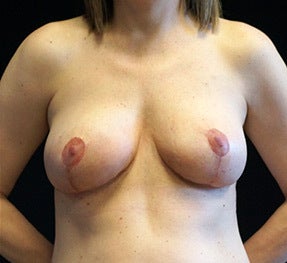 Breast Lift Following Saline Implant Removal after 1076321