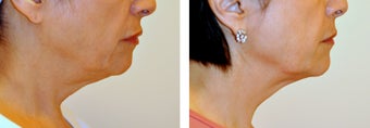 63 Year Old Female Treated with Ultherapy for sagging neck before 996277