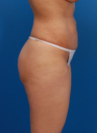 35-44 year old woman treated with Tummy Tuck 1566564