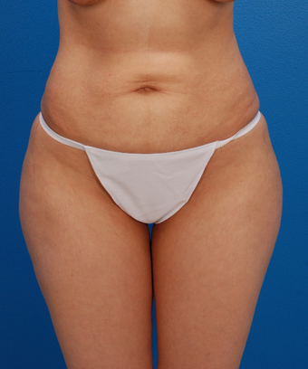 35-44 year old woman treated with Tummy Tuck before 1566564