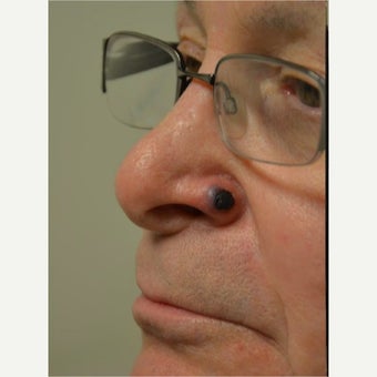 55-64 year old man treated with Mole Removal/ Skin Cancer removal and reconstruction before 1966434