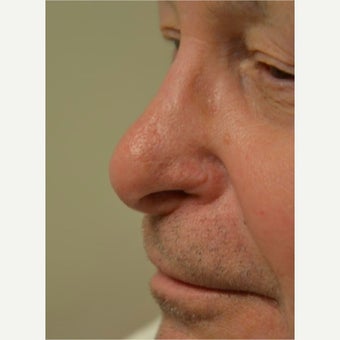 55-64 year old man treated with Mole Removal/ Skin Cancer removal and reconstruction after 1966434