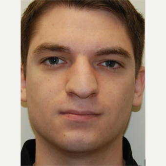 25-34 year old man treated with Rhinoplasty before 3792776